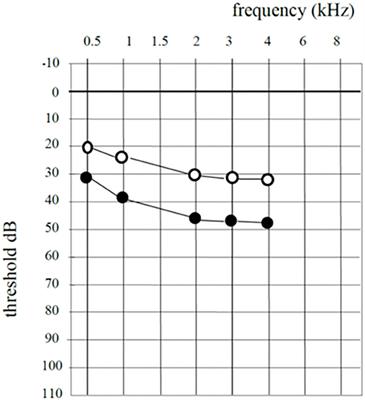 Sensorineural Hearing Loss After Balloon Eustachian Tube Dilatation